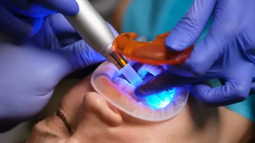 Diodowe lasery stomatologiczne w leczeniu kanałowym