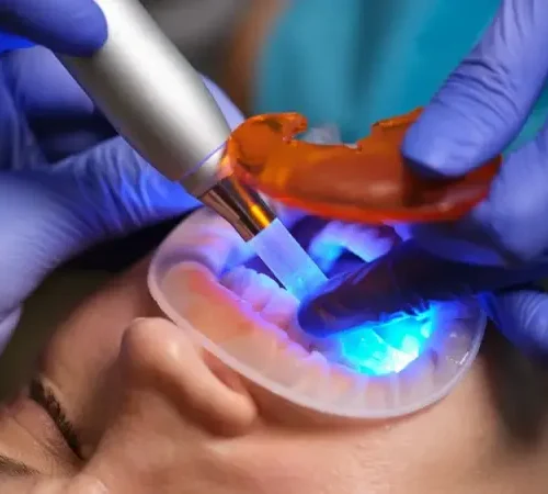 Diodowe lasery stomatologiczne w leczeniu kanałowym
